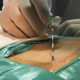 En el Hospital San Juan de Dios de La Plata se hizo una inédita intervención para tratar arritmias