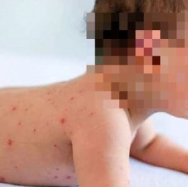 Alerta Sarampión: la Provincia de Buenos Aires y CABA, con tres nuevos casos